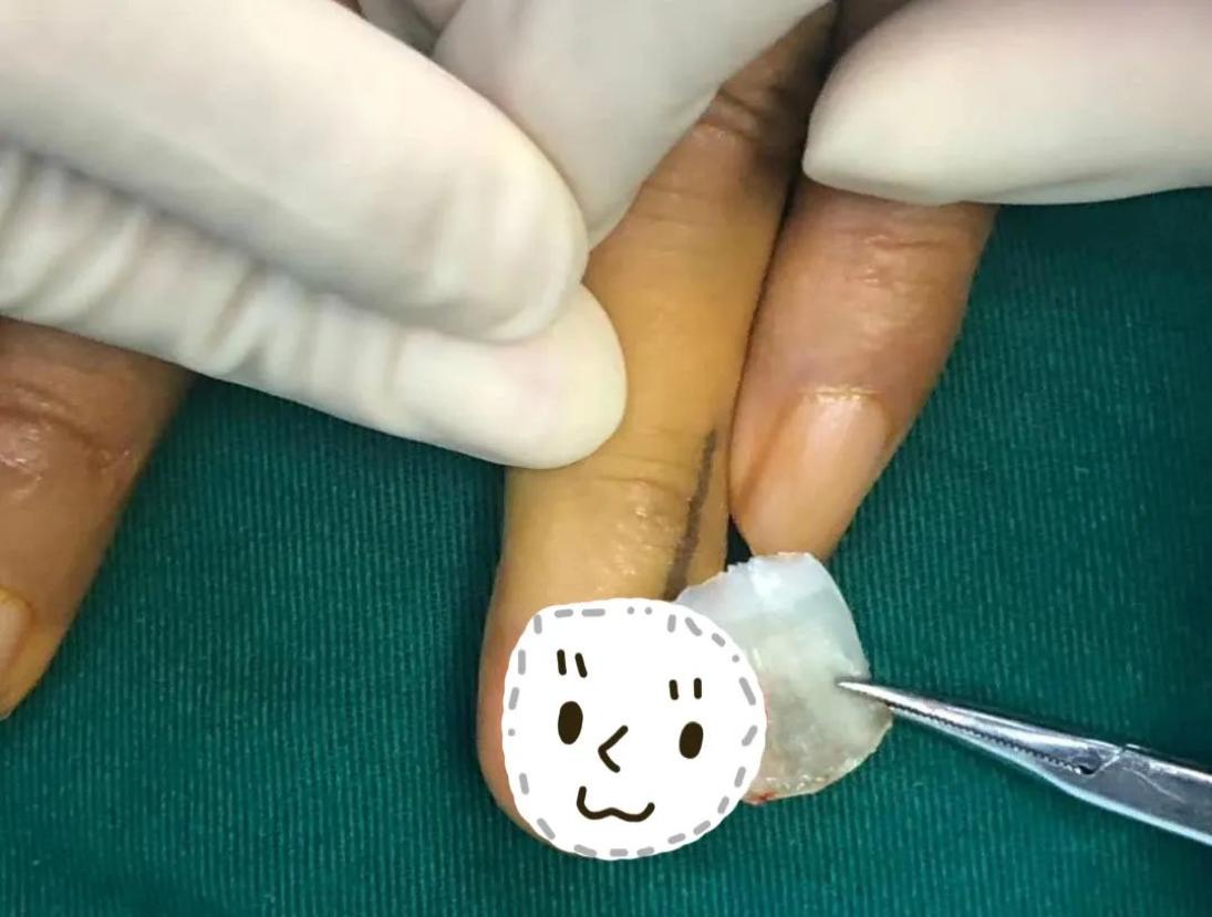 被鱼刺扎了手发紫了可以治疗好吗,被鱼刺扎破手有危险么