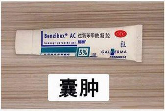 痘痘治疗推荐,闭口黑头痘痘痘印用什么药膏