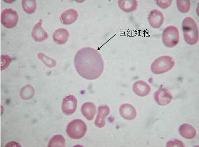 关于贫血诊断,贫血知识普及