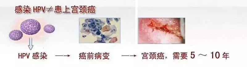 协和专家：感染HPV病毒不要怕，80%就像感冒，可自愈