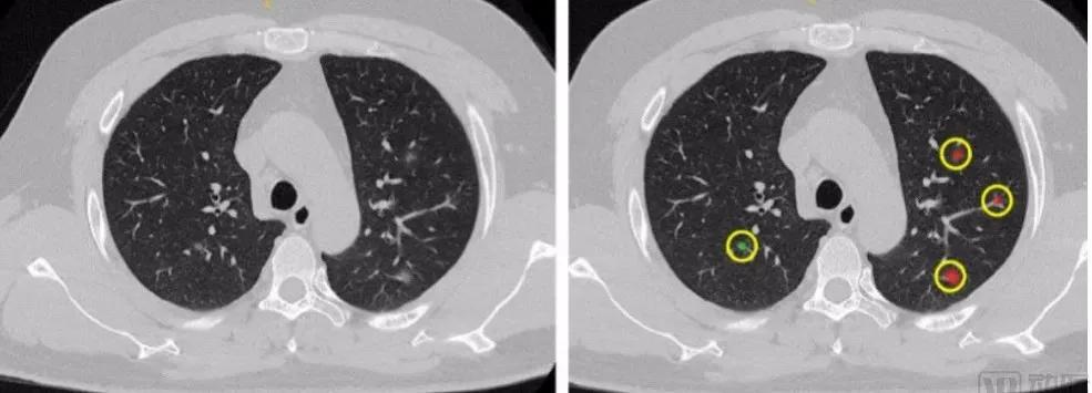 AI巡礼|联影智能，大放异彩的抗“疫”神器