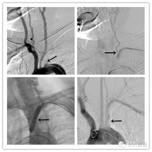 锁骨下动脉盗血综合征手术费用,锁骨下动脉盗血综合征中医怎么治