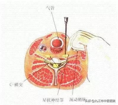 星状神经节阻滞治疗颈椎病,星状神经节阻滞能治颈椎病吗