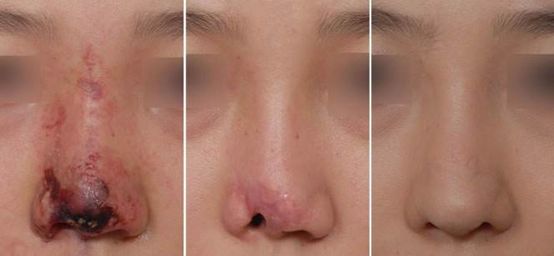 一次脸部微整形换来五年修复路,面部微整形美容前后对比