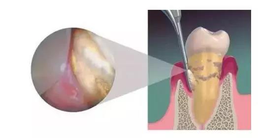 300洗牙贵吗,洗牙300和600元有什么区别