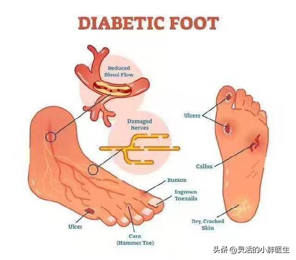 糖尿病足避免截肢的治疗原则,糖尿病足截肢后的护理问题