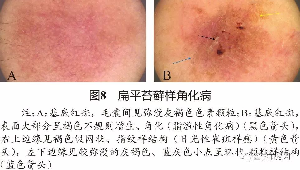 面部常见皮肤病皮肤镜诊断专家共识全文发布