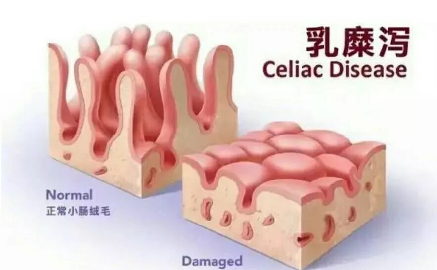 哪些问题属于内分泌失调,肠道菌群失调与甲状腺疾病有关