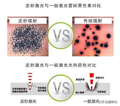 选择皮秒祛斑注意事项,选择光照美容仪的理由