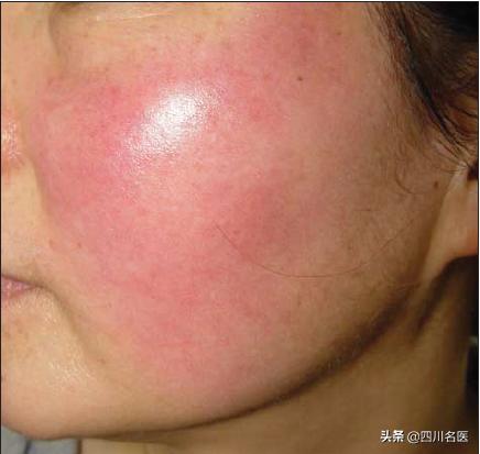 一把年纪了还总长痘,一把年纪了脸上还爆痘