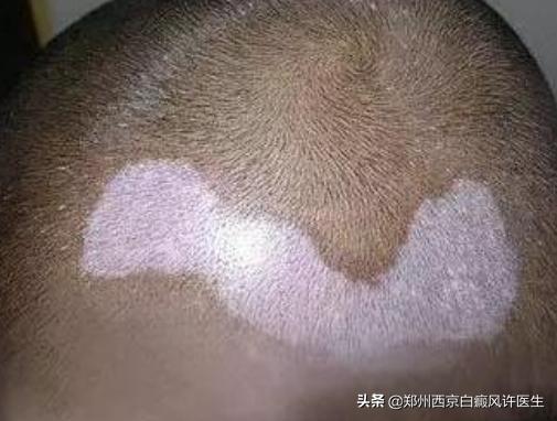 头部有白癜风可以用洗发水吗,头部有白癜风洗头注意事项