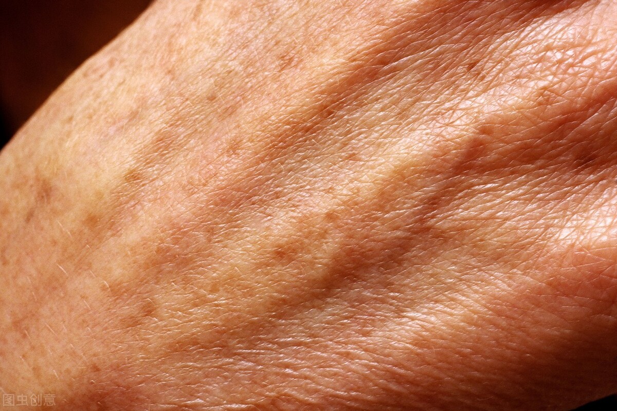身上老年斑怎么可以去除,身上长老年斑消除最好的方法