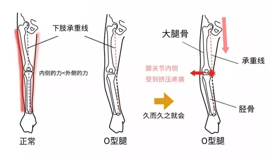 练就笔直大长腿，OX腿型如何应对？！｜运动康复003课