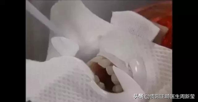 冷光美牙仪的危害,朋友圈冷光美牙仪