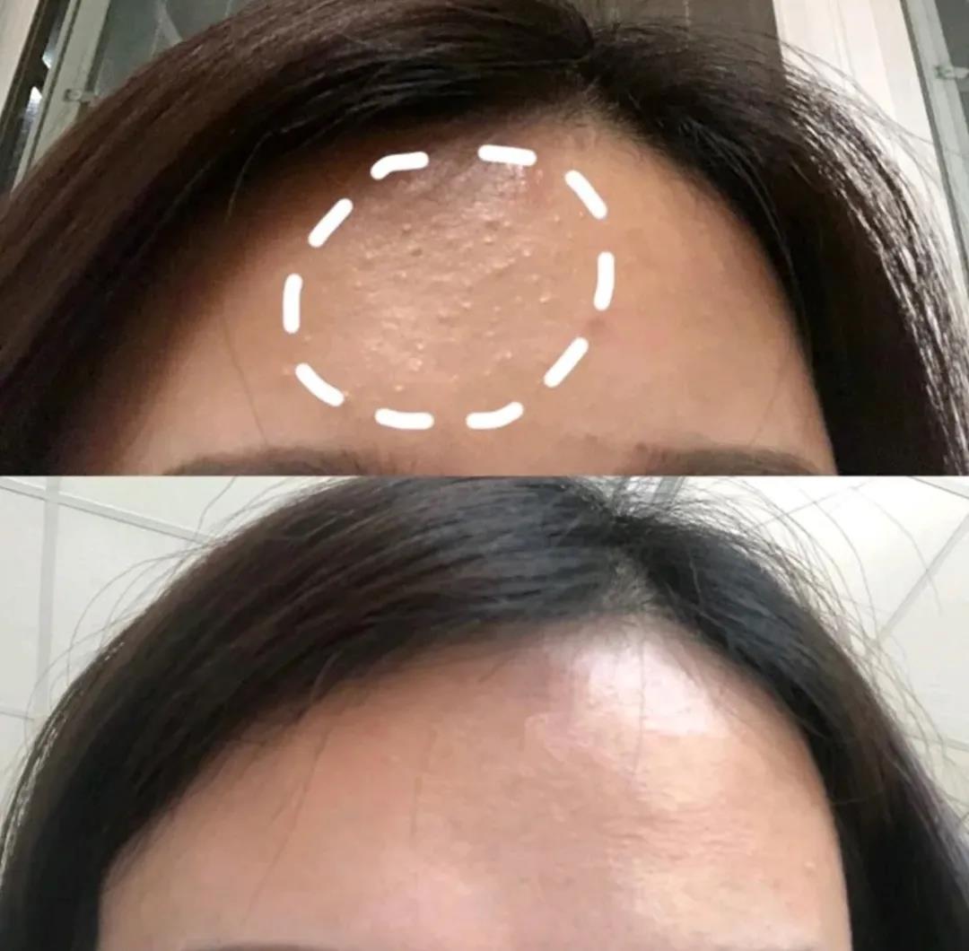 闭口应该怎么处理,闭口怎么办最有效的方法