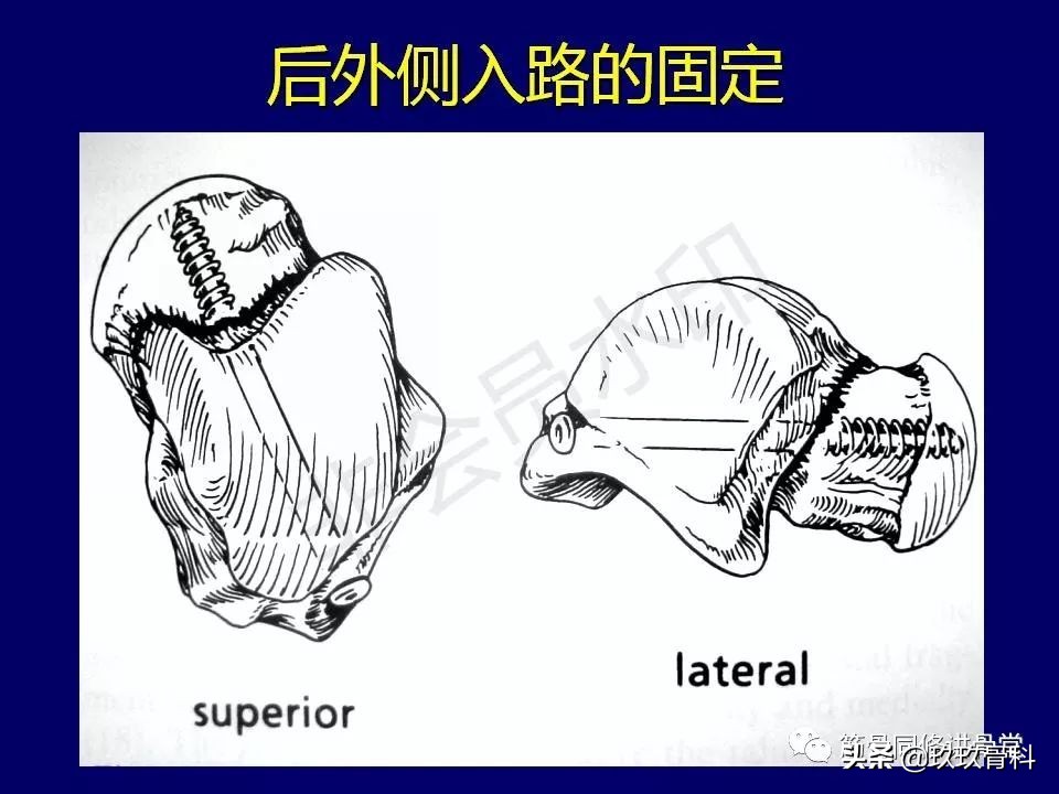 距骨骨折后遗症,距骨骨折怎么办
