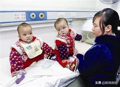 坐骨连体双胞胎多大分离,中国首例坐骨婴儿手术成功完整版