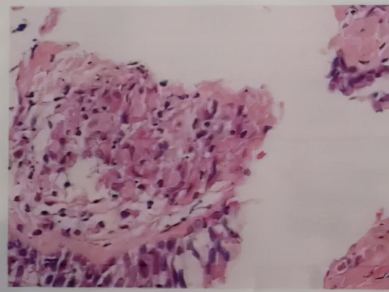 感觉身体淋巴结游走性疼痛,全身多处炎性淋巴结