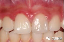 门牙折断牙根完好怎么办,门牙意外脱落怎么修复