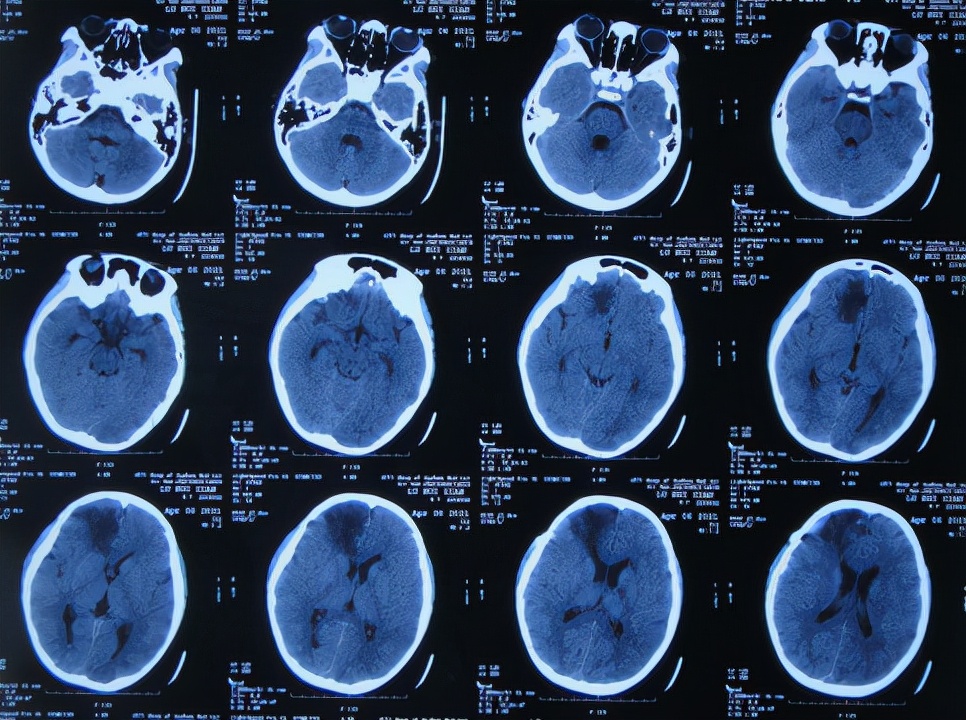 儿童脑出血昏迷三天后恢复正常了,脑出血后脑积水多久会出现症状