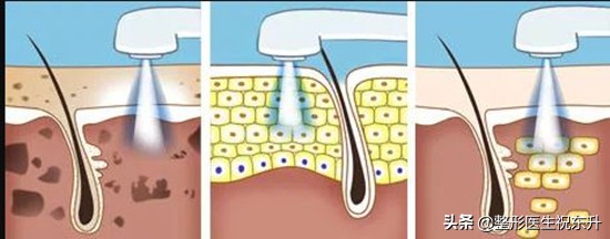 黑金光子嫩肤后的注意事项,皮肤黑做完光子嫩肤后的注意事项