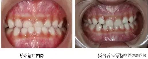 这个三岁的孩子笑的时候看不见上牙，吃饭嚼不烂就咽了