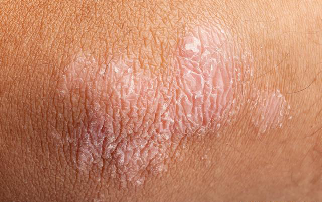 惹上牛皮癣这个大佬，脱发也来敲你的门？