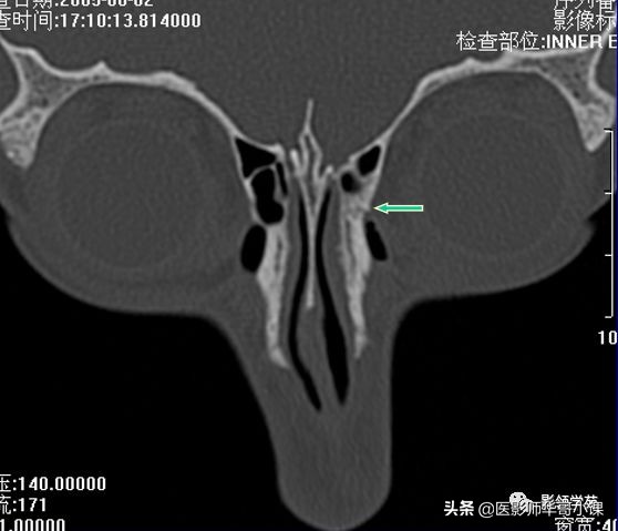 「鼻骨彩图」鼻骨CT解剖及骨折影像学诊断