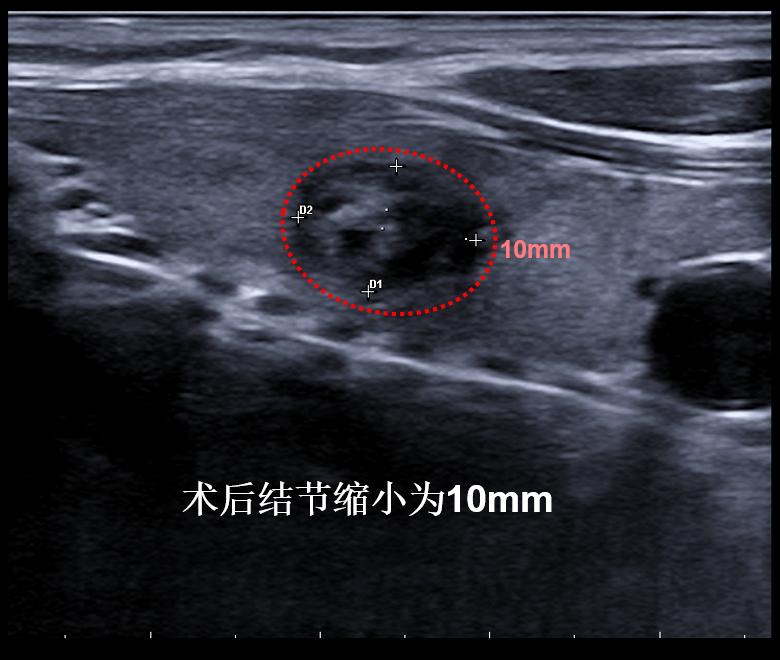 甲状腺结节微创消融手术,甲状腺结节微创消融医保