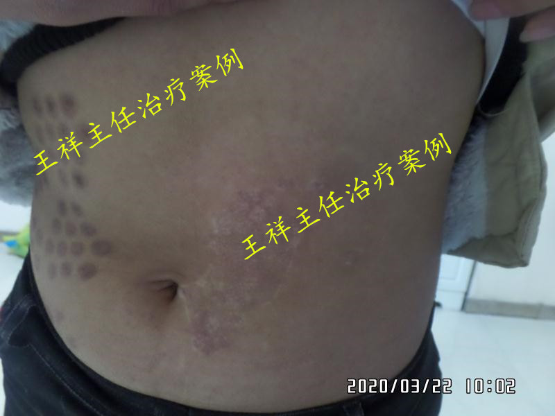 白癜风黑色素种植效果好吗,黑色素种植治疗白癜风费用