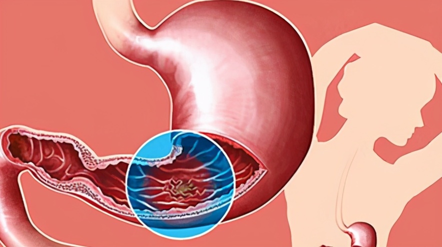 饭后2至3小时胃疼胃溃疡怎么了,饭后上腹部疼胃溃疡
