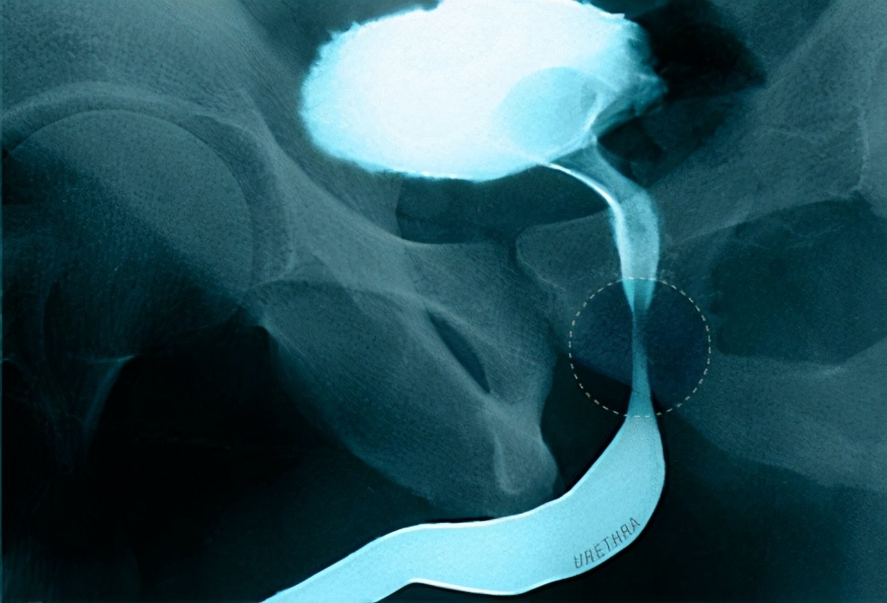 23岁前列腺肥大是什么原因引起,前列腺增生肥大吃什么缓解症状