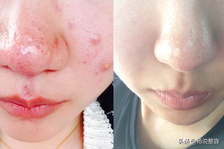 科普什么是酒渣鼻,科普一下你不知道的酒的小知识