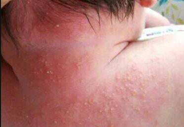 宝宝热出痱子婆婆说烂胎盘,高温天气宝宝热痱子怎么治好得快