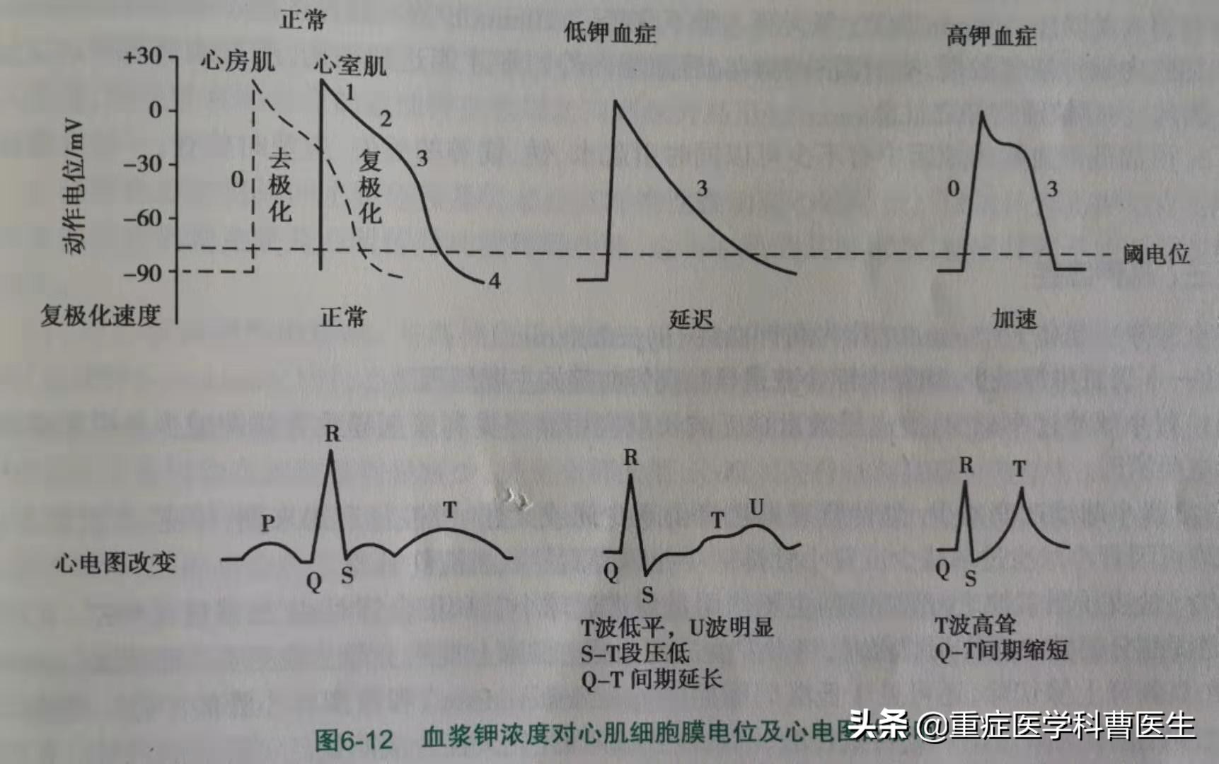 什么是高钾血症,高钾血症什么引起