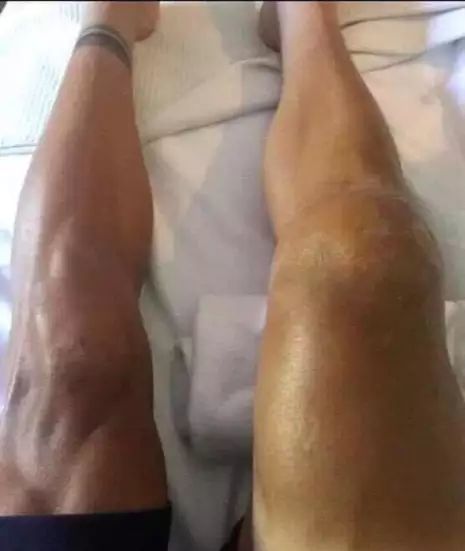 acl伤势对伦纳德有什么影响,范戴克伤停最新消息