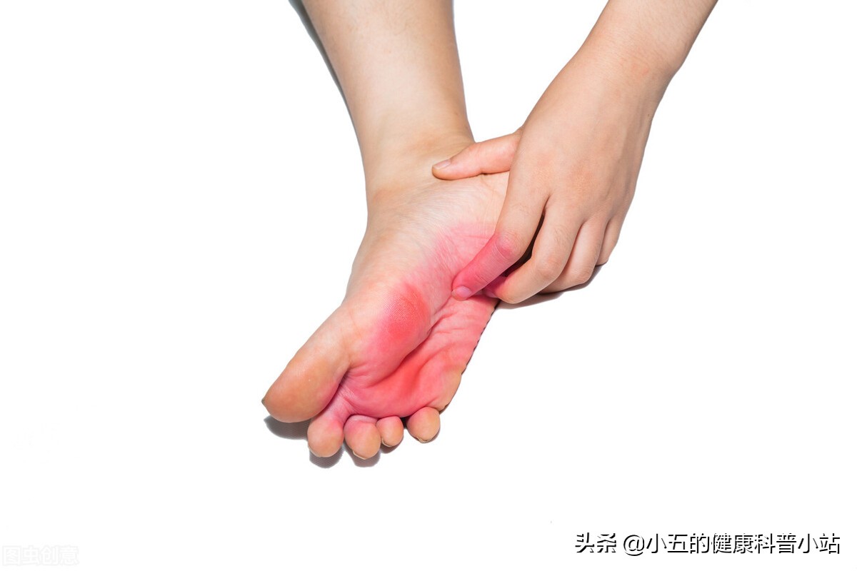 足癣不是真菌感染怎么治,足癣怎么治疗好得快