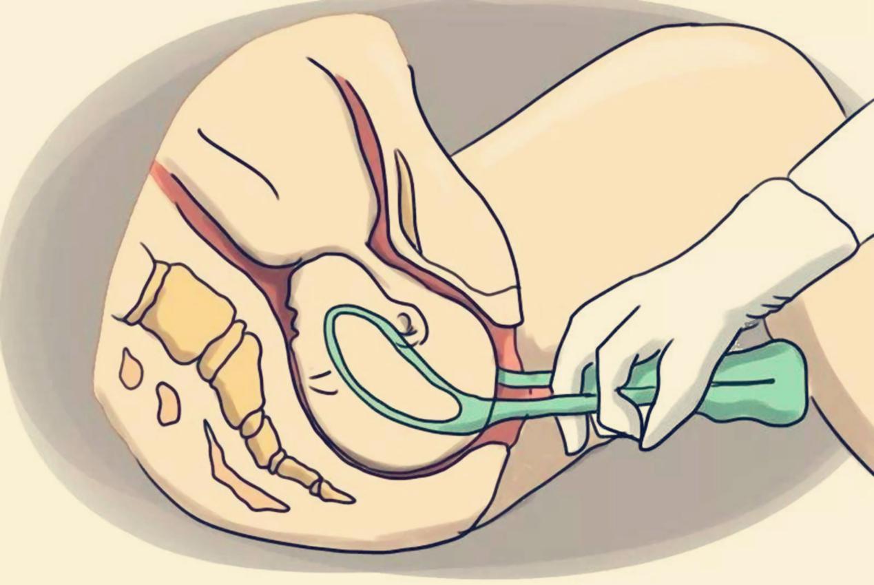 分娩时要不要使用产钳,哪些情况不能用产钳助产