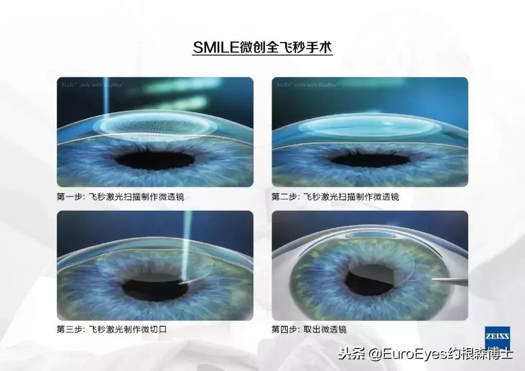 全飞秒3.0和2.0的区别,半飞秒和全飞秒区别都多少钱