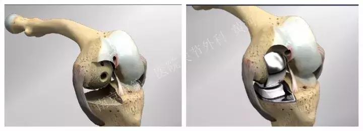 膝关节问题讲解,关于关节炎的问题