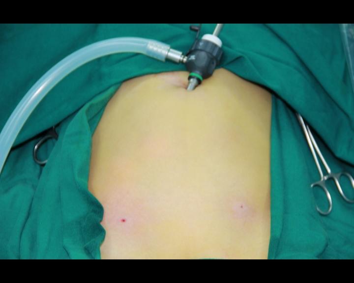 睾丸鞘膜积液和疝气能长好吗,鞘膜积液和疝气能一起做手术吗