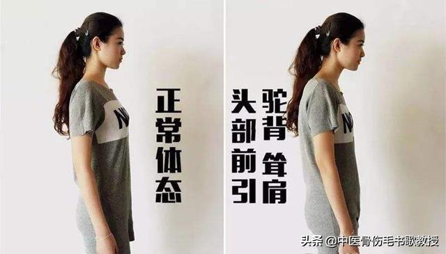驼背影响美观一个动作改善驼背,驼背矫正方法每天10分钟改善驼背