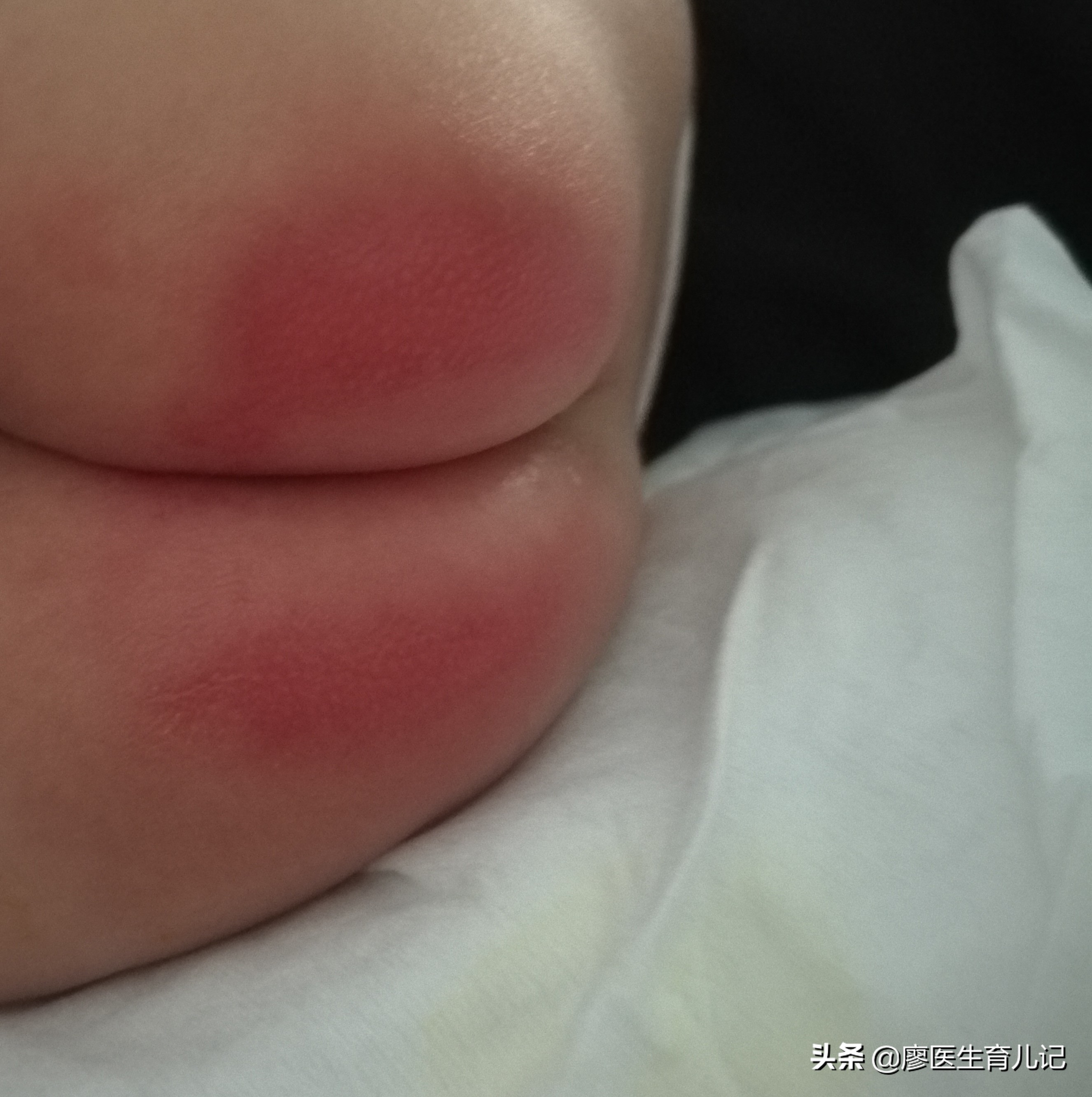 宝宝红屁股怎么办具体护理方法,宝宝红屁股了怎么好得快