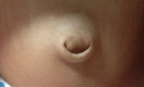 宝宝肚脐鼓起一个大包,宝宝肚脐鼓包