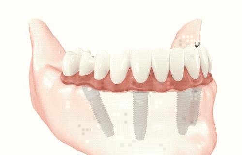 日照口腔牙齿矫正费用,日照牙科修牙多少钱一颗