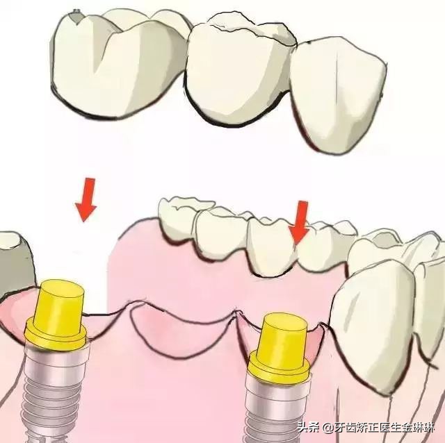 牙齿矫正每次加力都很痛,牙齿矫正每次加力都疼