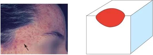 痘痘为什么越来越多如何正确祛痘,祛痘痘的效果是长痘痘还是消痘痘