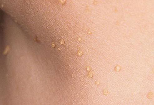 脖子旁边出现小肉粒能直接揪掉吗,脖子和腋下长的小肉揪怎么去除