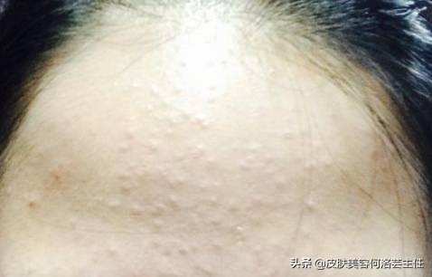 疮有什么症状怎么治,疱疹是怎么引起的