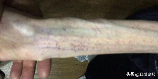 高三女生3个月只吃黄瓜,瘦到只剩76斤!子宫停止发育只有拇指大